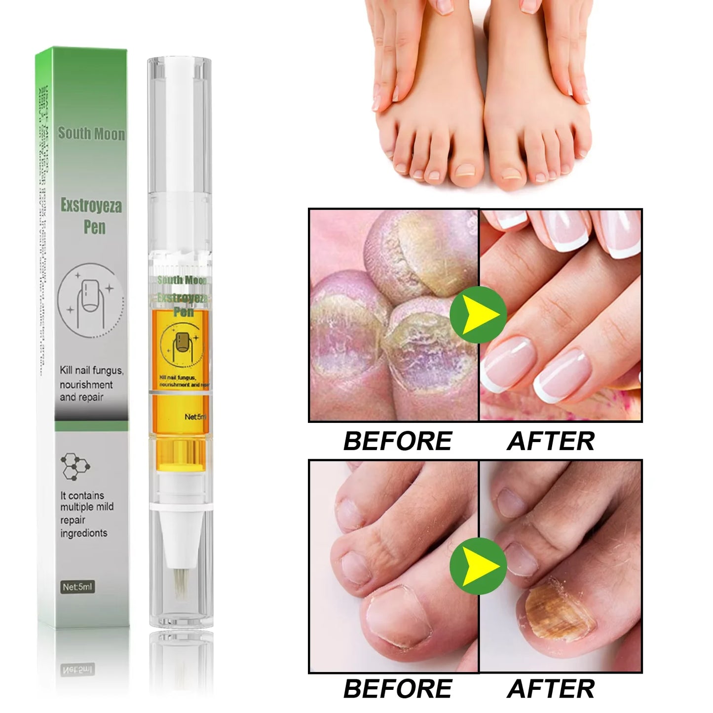 South Moon Nail Fungus Repair Pen Remove Onychomycosis Paronychia Reduce Toe Infection Brighten Nail Hand Foot Nail Care Liquid
